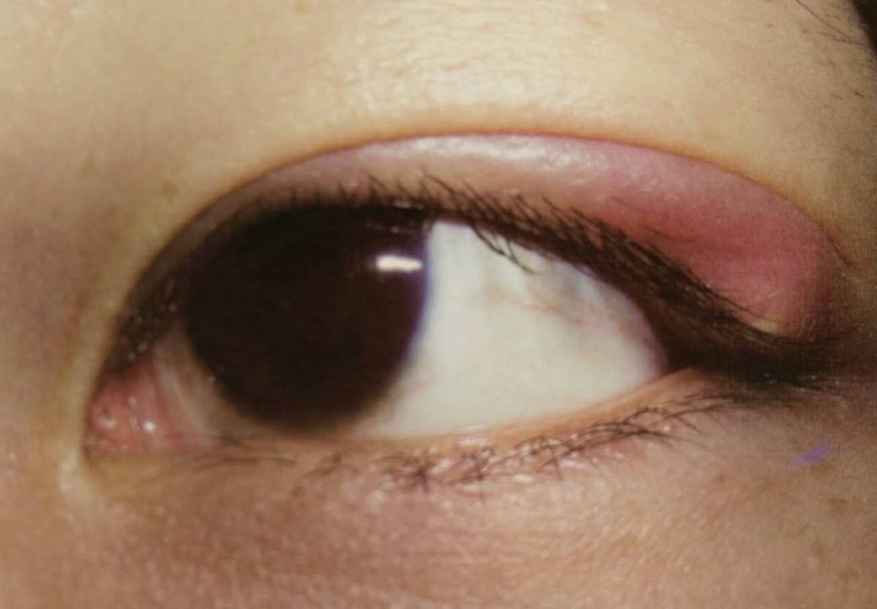 去除针眼中医疗法,针眼总不好怎么办