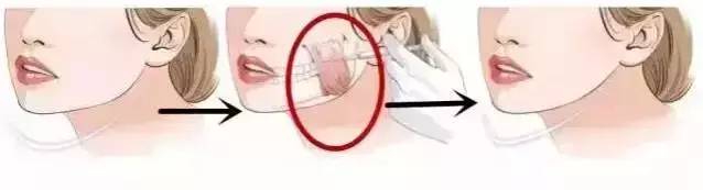 哪种脸型不能打瘦脸针,哪些脸型不适合打瘦脸针