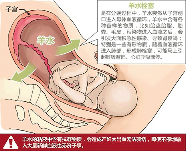 羊水栓塞是什么样的图片,羊水栓塞是什么原因引起