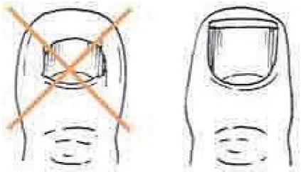 糖尿病足的预防重于治疗,糖尿病足病预防案例