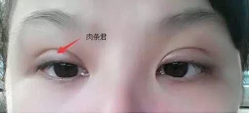 双眼皮怎么割没肉条感,双眼皮怎么显得更宽