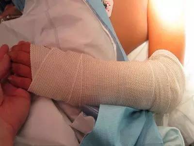 小儿骨折的危害有哪些,小儿骨折不愈合怎么处理