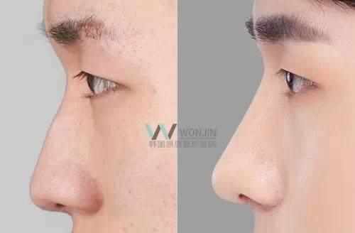 鼻子做假体隆鼻有什么坏处,隆鼻以后老了鼻子会怎样