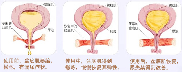 渭南市妇幼保健院妇科,渭南妇幼保健院盆底肌修复