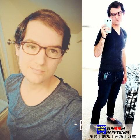 雌激素治脱发,雄性激素脱发补充雌性激素有用吗