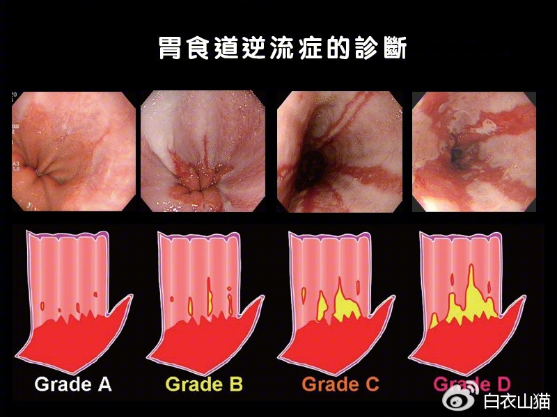 咽痛咳嗽吃消炎药没用,喉咙发炎医生让我管住嘴