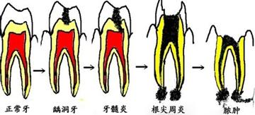 根管治疗的适应症有哪些？需要多少钱？