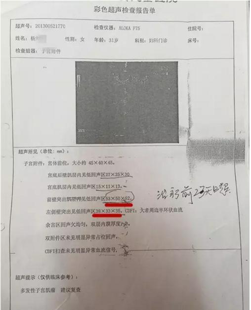 肌瘤消除方法,肌瘤消融疗法