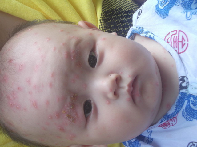 六个月宝宝出水痘发烧了怎么办,六个月宝宝感染水痘