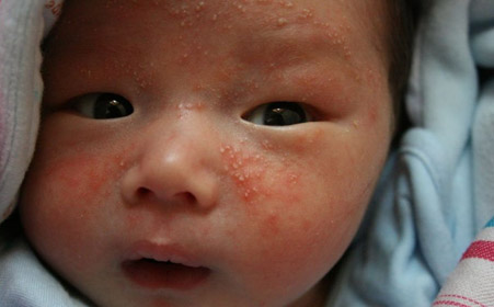 治疗湿疹要不要用激素药,湿疹不含激素药膏