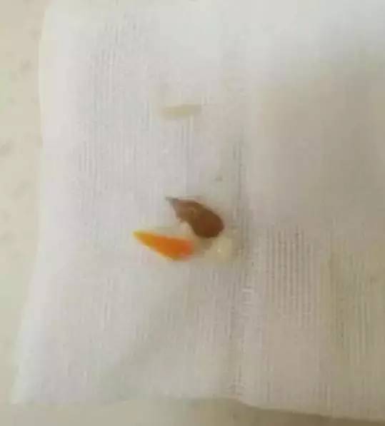 男孩咳嗽一星期被发现白肺,8个月男童反复咳嗽