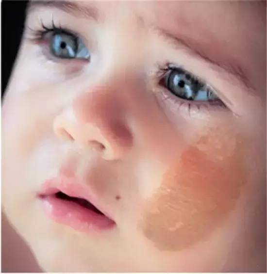 哪些胎记有危险,宝宝胎记是什么原因造成的