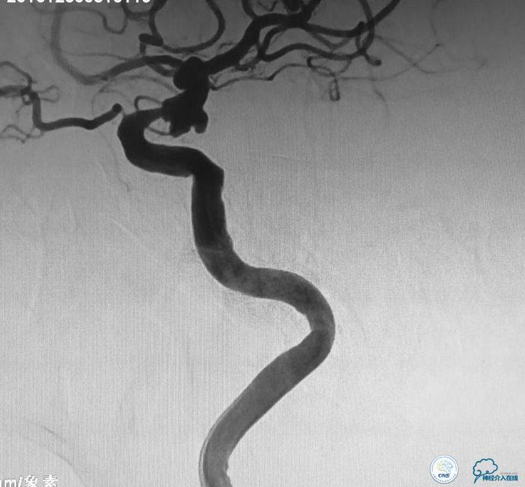 支架辅助弹簧圈栓塞治疗狭窄伴复杂动脉瘤
