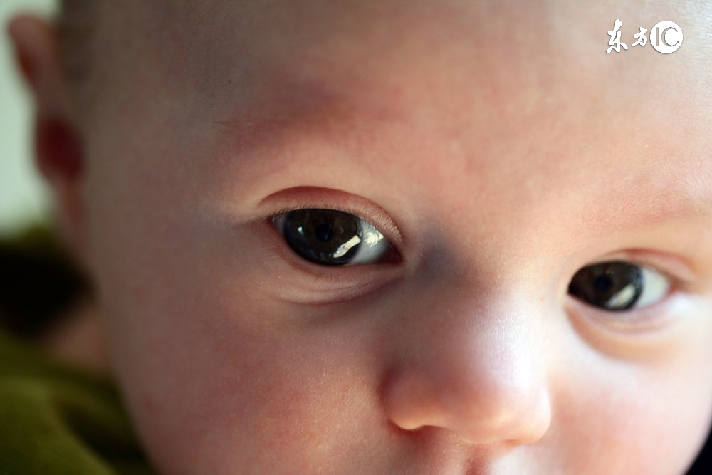 霰粒肿和麦粒肿是一样的吗,麦粒肿和霰粒肿有什么危害