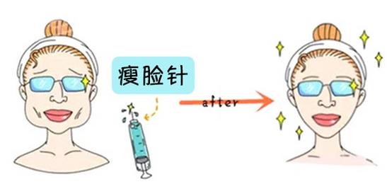 瘦脸针注射次数多了还会有效吗,瘦脸针注射多久后可以恢复自然
