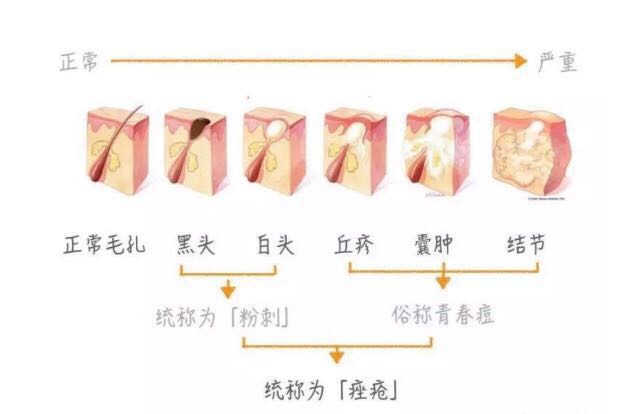痘痘老是反复的看过来