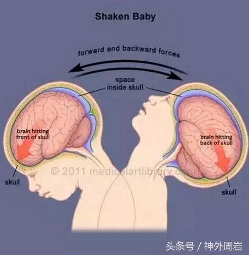 摇晃宝宝致死是真的吗,怎样判断摇晃对婴儿造成了脑损伤