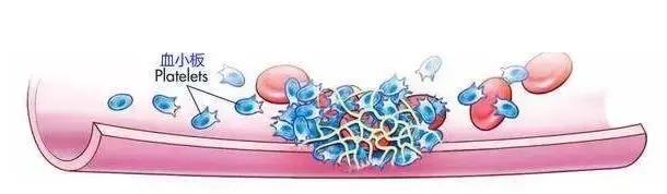 血小板减少性紫癜是大病吗好治吗,血小板减少紫癜是什么病能治好吗