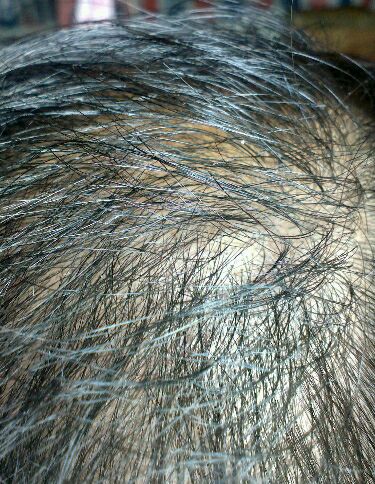 为什么最近老是掉头发呢?|年轻人脱发的七大原因