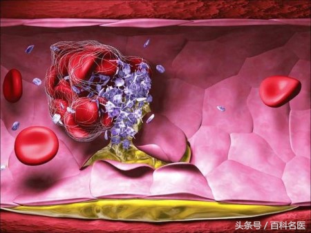 哪些人是动脉粥样硬化的高危人群,动脉粥样硬化该怎样预防和治疗