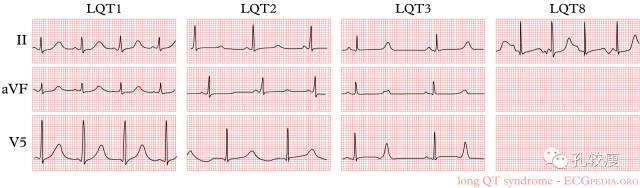 qt和qtc间期正常值范围,qtc间期