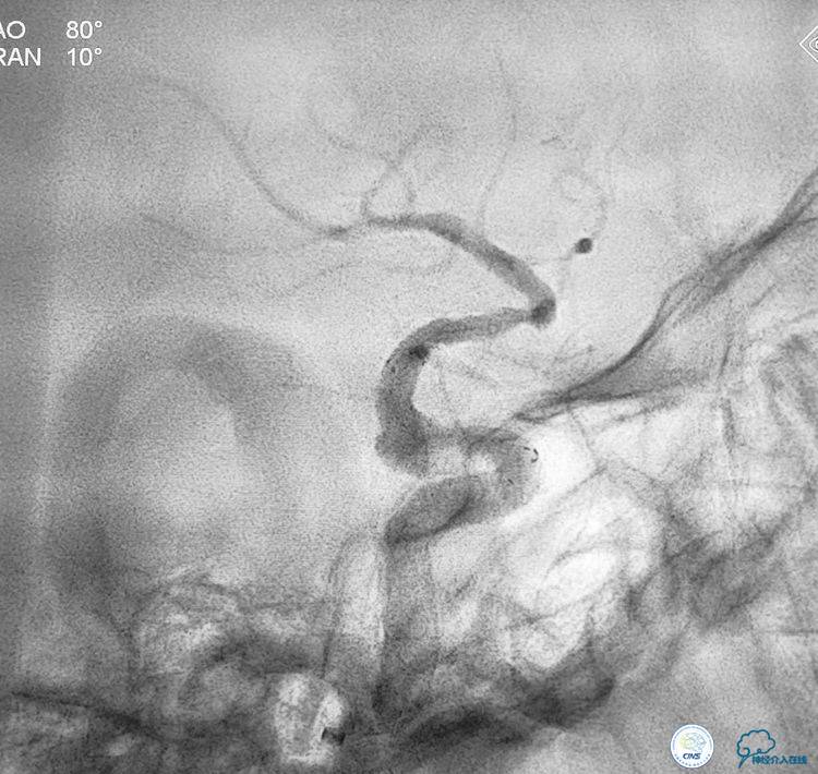 支架辅助弹簧圈栓塞治疗狭窄伴复杂动脉瘤
