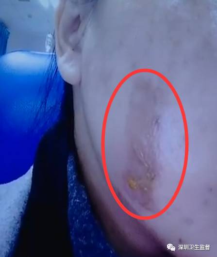 超声刀抗衰老效果,超声波抗衰美容效果怎么样