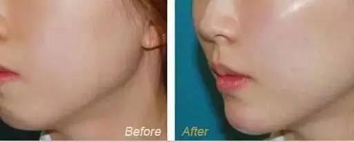 整形医生聊内幕瘦脸针,揭秘医美内幕水光针