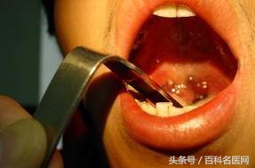 扁桃体发炎怎么办最快最有效缓解,扁桃体发炎高烧39.5度反复发作