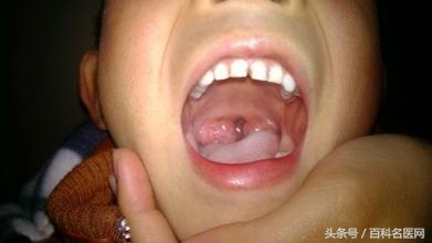 扁桃体发炎怎么办最快最有效缓解,扁桃体发炎高烧39.5度反复发作