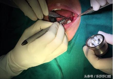 种植牙到底有多痛苦,种植牙真实经历详细全部过程