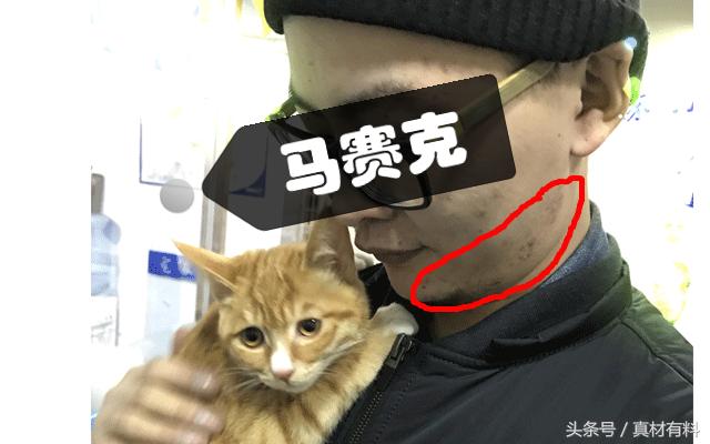 下巴刮完胡子就长痘痘,胡子部位长痘痘怎么办