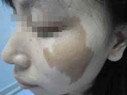 宝宝咖啡斑长在眼皮上,宝宝咖啡斑自己消失了