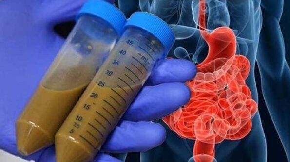 便秘请吃翔？揭秘粪便胶囊