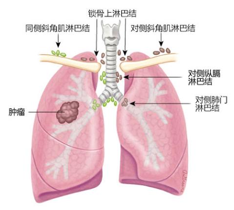 关于癌症你一定要知道的事,肺癌家属应该知道哪些问题