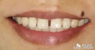 门下门牙有缝隙怎么补救,门牙开缝怎么处理最好