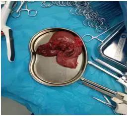 胃转流手术治疗二型糖尿病靠谱吗,郑州胃转流手术治疗糖尿病