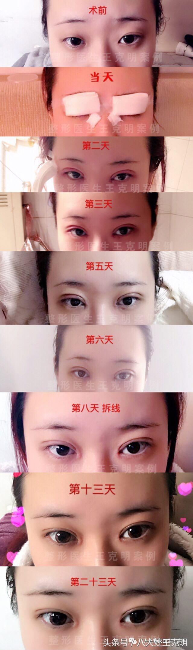 双眼皮有肉条怎么消肿最快,双眼皮术后疤痕怎么能彻底消除