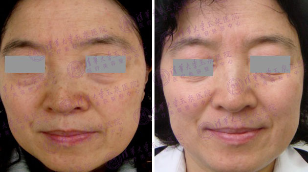 初春皮肤问题多，光子嫩肤一招制胜！