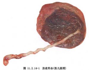 胎盘剥离征象,胎盘低置状态