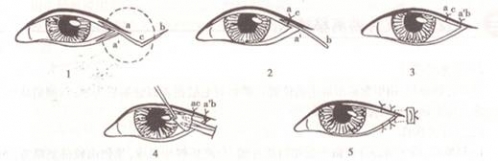 内眼角去哪里开,内眼角怎么开眼角