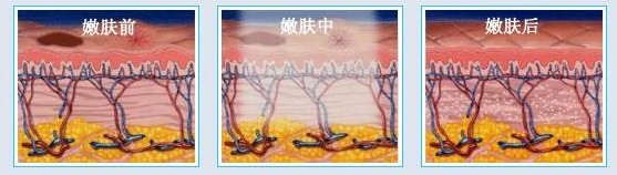 初春皮肤问题多，光子嫩肤一招制胜！