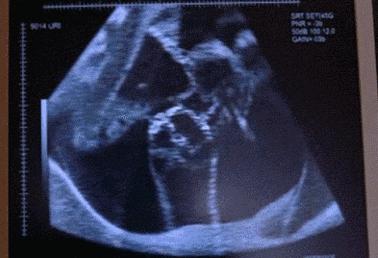 这四种是胎儿的求救信号，孕妈快重视起来！