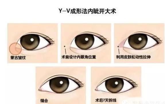 内眼角去哪里开,内眼角怎么开眼角
