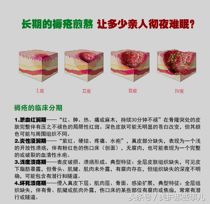 褥疮发炎可用碘伏消毒再抹膏药吗,褥疮能不能用黑药膏和红霉素