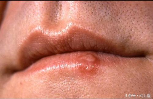 图解成年人常见的皮肤问题