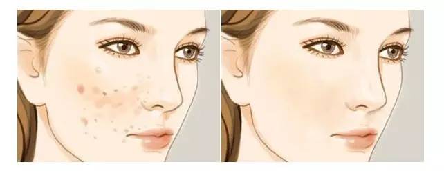 长痘痘的脸容易抗老吗,长痘的人抗老吗