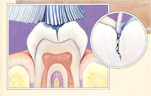 孩子天天刷牙竟然患龋齿怎么办,孩子每天都刷牙为什么还会有龋齿