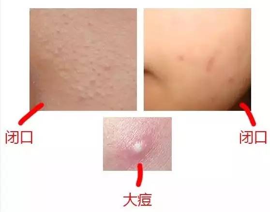闭合性粉刺爆浆,闭合性粉刺还有痘印