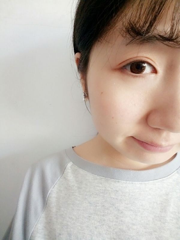 双眼皮全切手术恢复期,全切双眼皮恢复期眼尾分叉正常吗